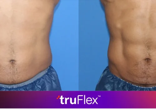TruFlex Muscle Strengthening Procedure