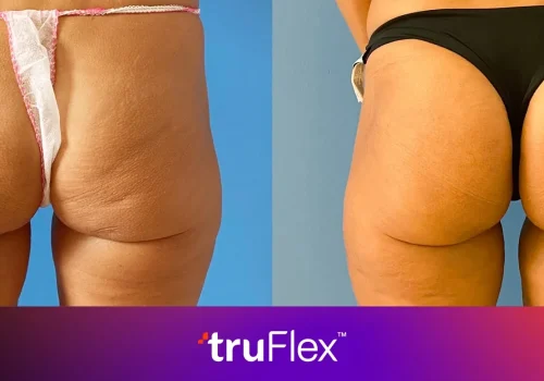 TruFlex Workout-Equivalent Therapy